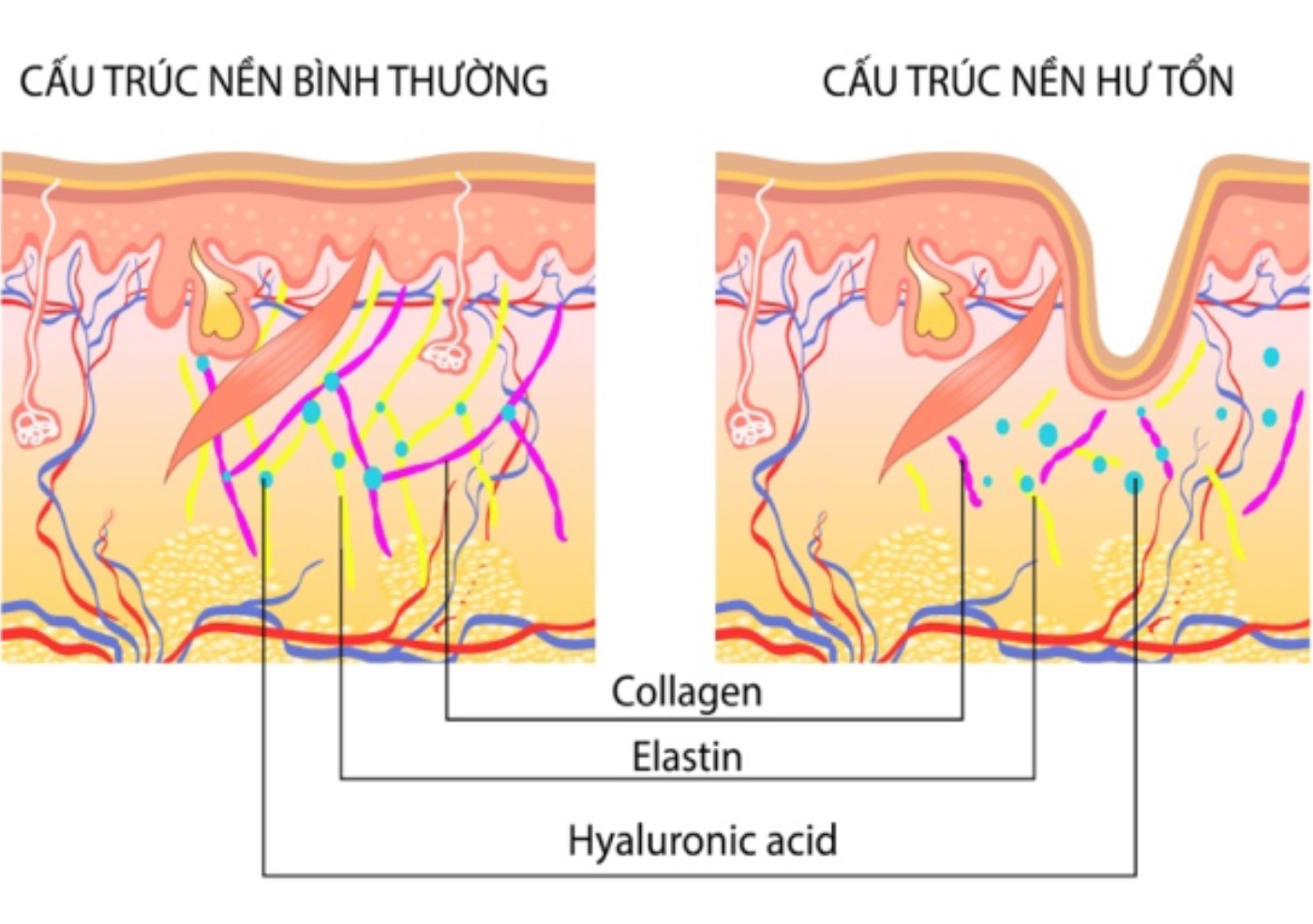 Kem dưỡng ẩm Hyaluronic Acid giúp tái tạo trẻ hoá da, cấp ẩm cho da từ sâu bên trong